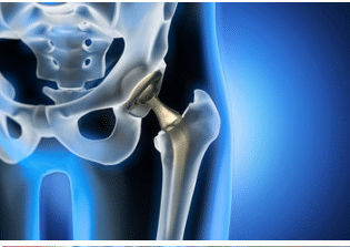 Artrosi anca : sintomi e terapie