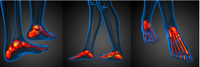 Artrosi caviglia del piede