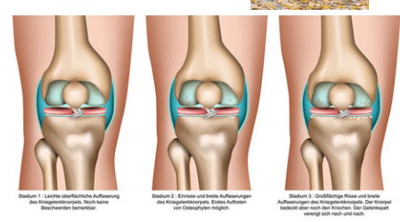 Artrosi ginocchio
